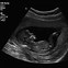 Image result for First-Trimester Ultrasound