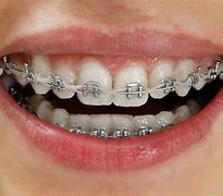 Image result for Metal Braces