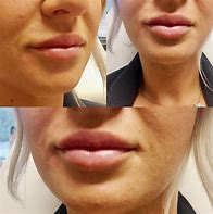 Image result for Juvederm Lip Filler