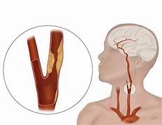 Image result for Carotid Artery Occlusion Stroke