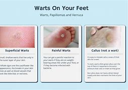 Image result for Foot Common Wart Removal