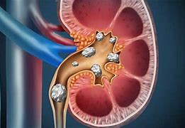 Image result for Kidney Stones Human Body