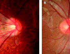 Image result for Optic Disc