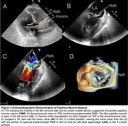 Image result for Echocardiogram of Cardiogenic Shock