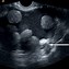 Image result for Involuting Ovarian Cyst Ultrasound