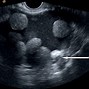 Image result for Ultrasound 5 Cm Ovarian Cyst