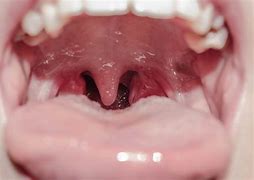 Image result for 2 Bumps On Back of Tongue