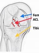 Image result for ACL Injury Cartoon