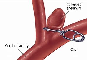 Image result for Cerebral Aneurysm Clipping