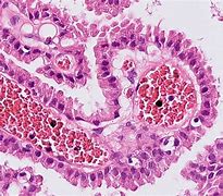 Image result for Choroid Plexus Papilloma Carcinoma