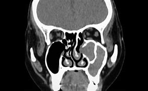 Image result for Photos of Sinus Cancer