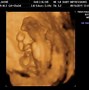 Image result for Acrania Ultrasound