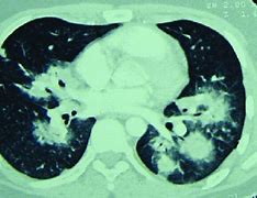 Image result for Ground Glass Nodule 10 mm Upper Right Lung