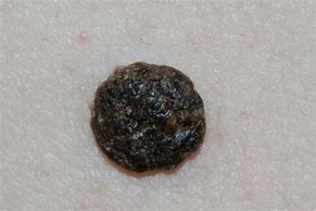 Image result for Black Seed Wart
