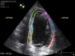 Image result for Heart Echocardiogram Results