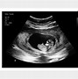 Image result for 8 Weeks 1 Day Ultrasound