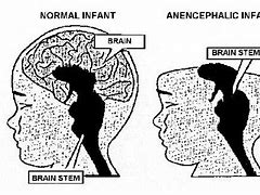 Image result for Anencephaly Fetal Ultrasound