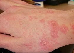 Image result for Pictures of Skin Rashes On Wrist