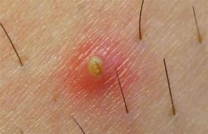 Image result for Ingrown Hair On Head