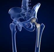 Image result for Hip Bone Replacement