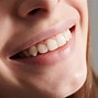 Image result for How to Fix a Gummy Smile