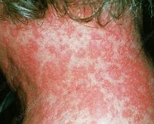 Image result for Allergic Drug Reaction Rash