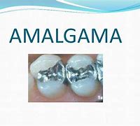 Image result for amalgama4