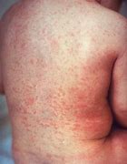 Image result for Unexplained Rashes On Skin