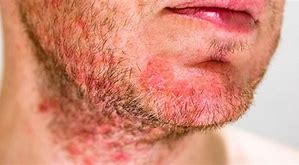 Image result for Skin Infection Folliculitis