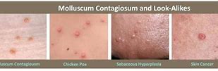 Image result for Molluscum Contagiosum Look Like When Getting Better