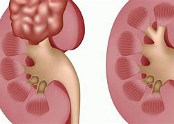 Image result for Complex Cyst On Kidney Pole