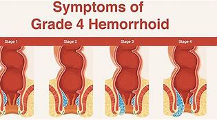 Image result for hemorroide