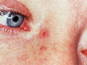 Image result for Basal Cell Mole