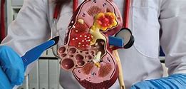 Image result for Kidney Cyst Removal
