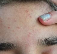 Image result for Red Bumps On Face Not Pimples
