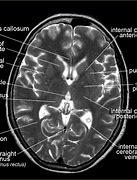 Image result for CT Scan Brain Anatomy
