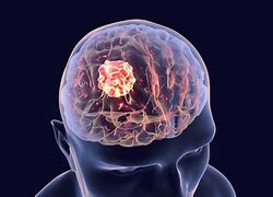 Image result for Human Brain Tumor