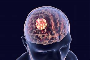 Image result for Brain Tumor Types