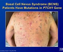 Image result for Basal Cell vs Melanoma