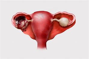 Image result for Endometrial Cyst Moving around in Abdomen