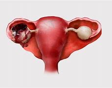 Image result for Endometriosis Cyst