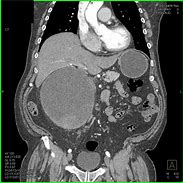 Image result for Complex Kidney Cyst MRI