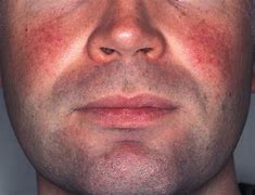 Image result for People with Rosacea