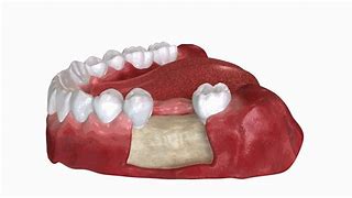 Image result for Jawbone Deterioration