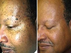 Image result for Large Mole Removal