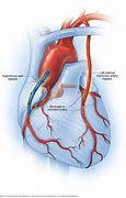 Image result for Coronary Artery Plaque Removal