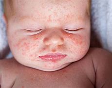 Image result for Baby Skin Rash On Face