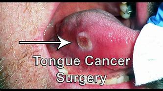 Image result for Tongue Carcinoma Laser