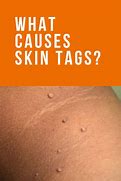 Image result for Skin Tags vs Genital Warts