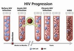 Image result for HIV E Aids